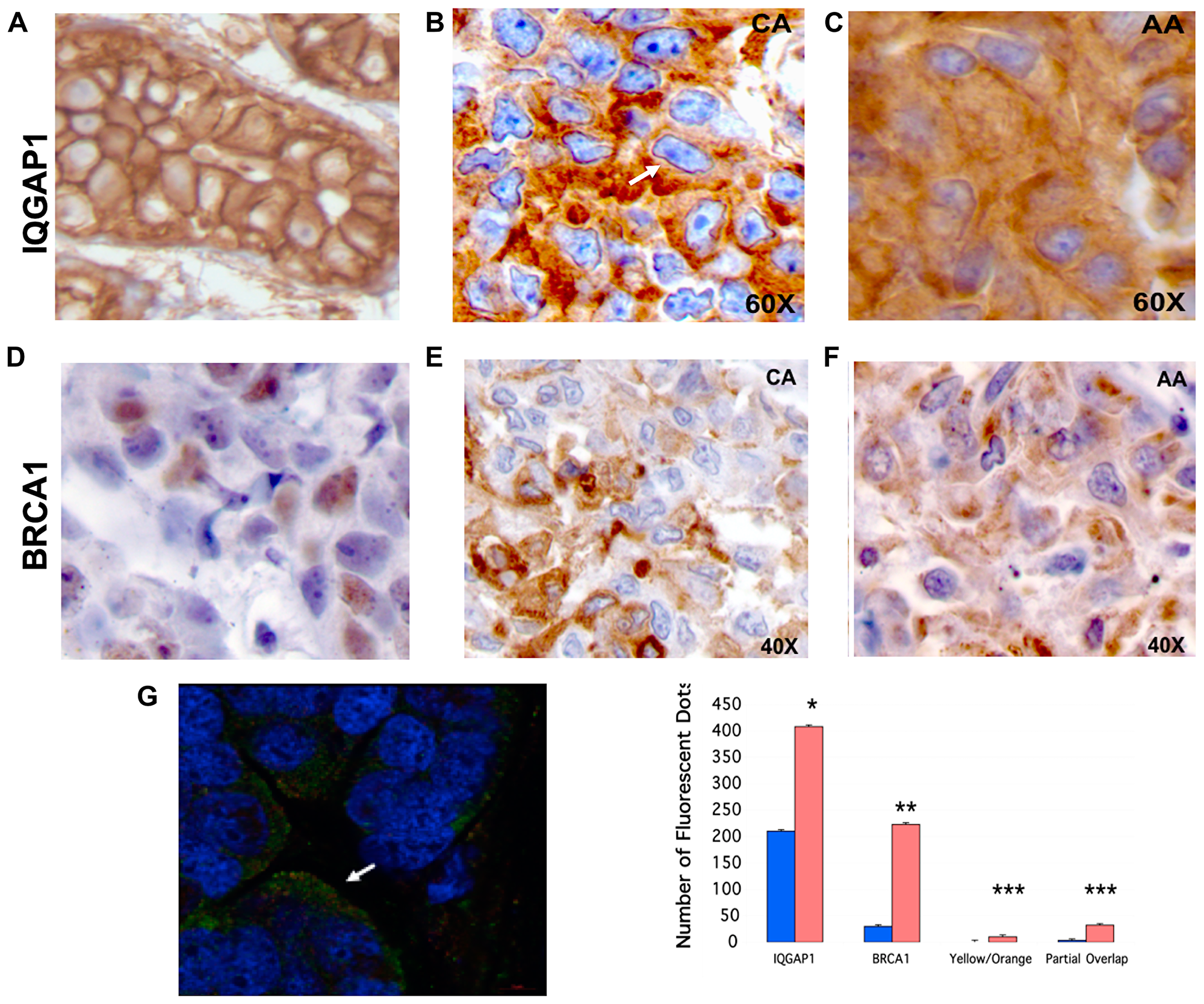 Figure 6: Mislocalization of IQGAP1-BRCA1 in human TNBC tumors phenocopies the dominant mutants and the TNBC cells.