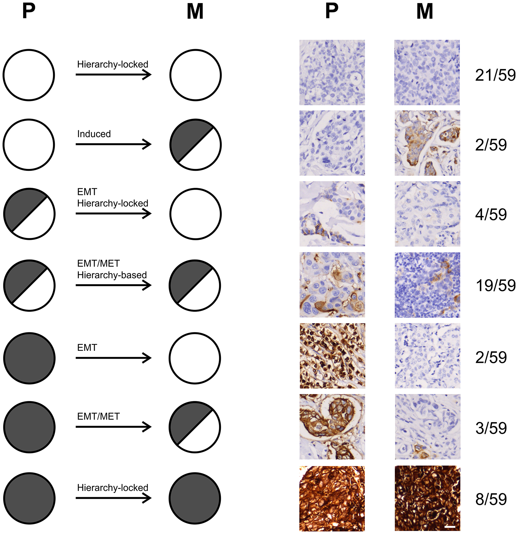 Figure 6: Proposed mechanisms of tumor dissemination from primary breast tumors to metastases.