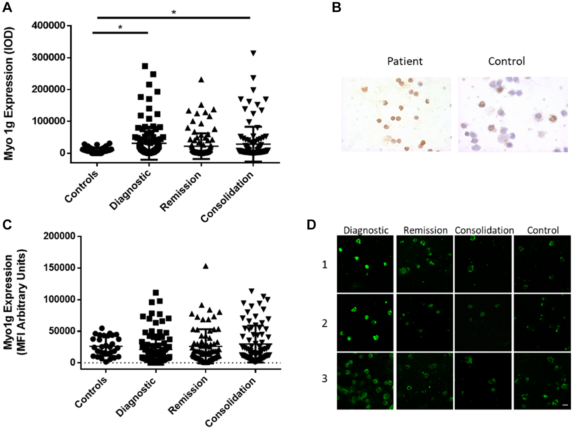 Figure 3: Myo1g over expression is conserved at protein level in acute lymphoblastic leukemia.