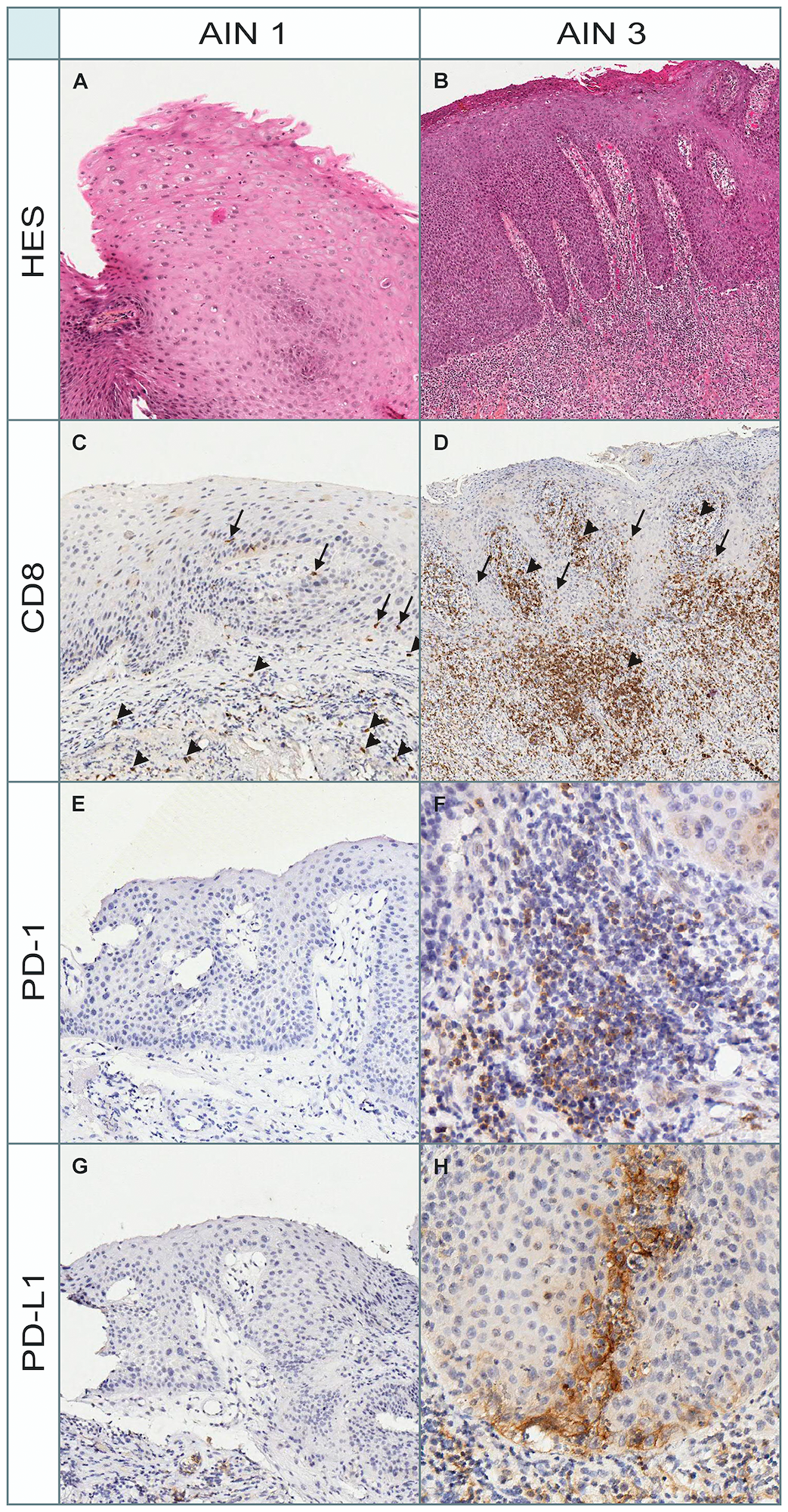 Figure 4: Morphological and immunohistochemical (PD-1, PD-L1, and CD8) aspects in a patient with AIN1 and AIN3.