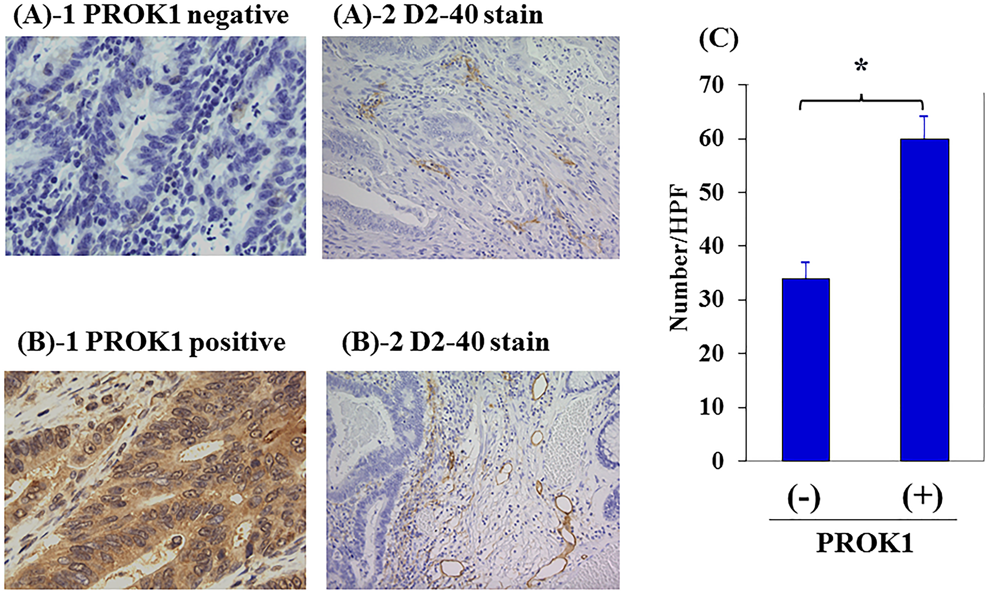 Figure 5: Lymph vessels in human primary colorectal cancer by immunohistochemical staining with anti-D2-40 mAb.