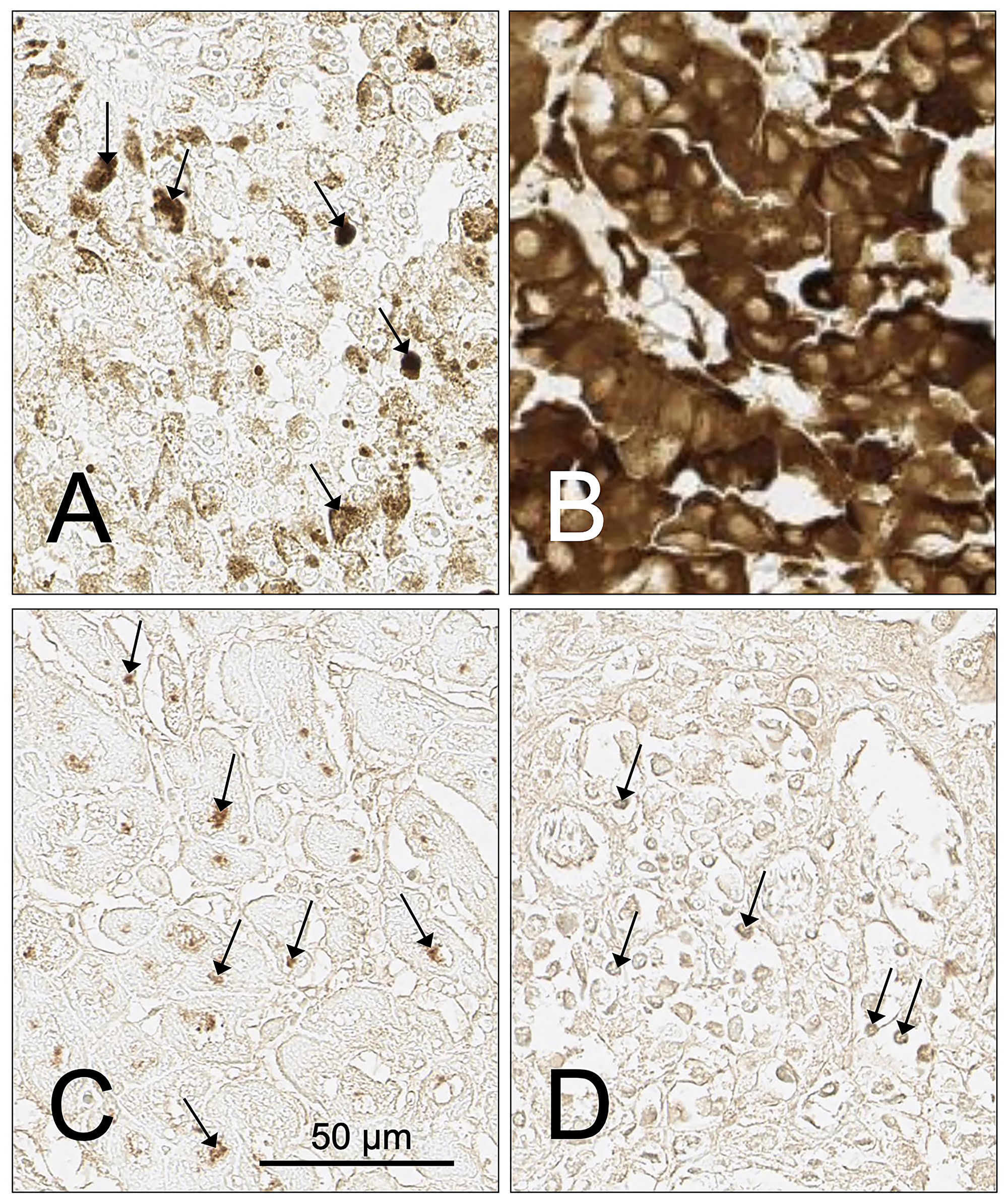 Figure 14: Examples of tumor cases with infiltrating lymphocytes or cells containing pigment that impact or prevent the assessment of SH7129 binding using DAB as a substrate.