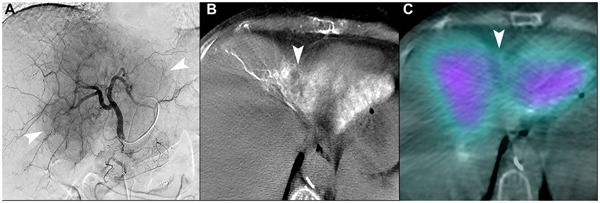 Figure 7: Unfavorable macrovascular and microvascular arterial conduit in two patients with intrahepatic cholangiocarcinoma.