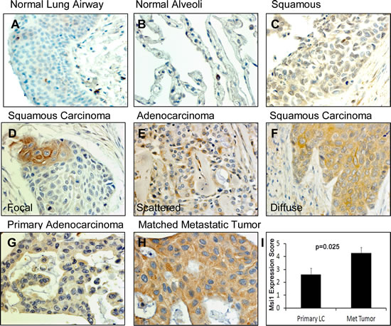 Msi1 expression patterns in lung cancers.