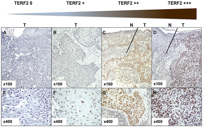 Determination of the TERF2 expression score.