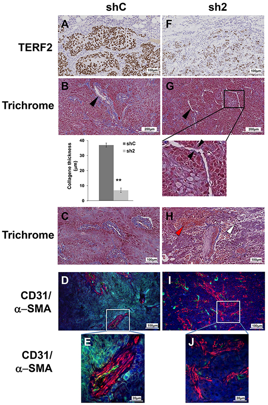 TERF2 down-regulation destabilized tumor vessels and induced fibrosis.