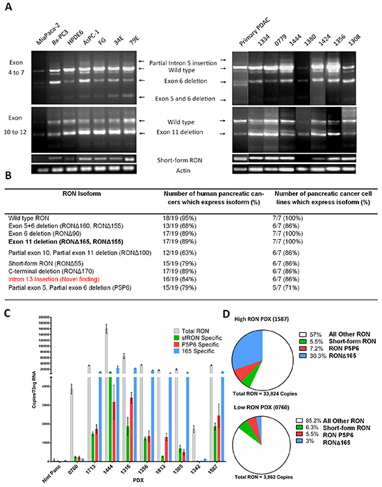 RON isoforms are highly expressed in human pancreatic cancer specimens.