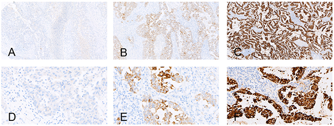 Examples of the immunohistochemical analysis of EML4-ALK.
