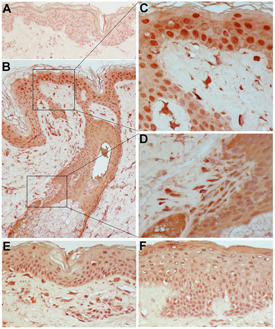 IFN-&#x03BA; is highly expressed in the lesional skin of patients treated with cetuximab.