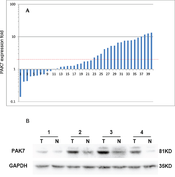 Expression of P21 protein (Cdc42/Rac)-activated kinase 7 (PAK7) in colon cancer tumors and adjacent normal mucosa.