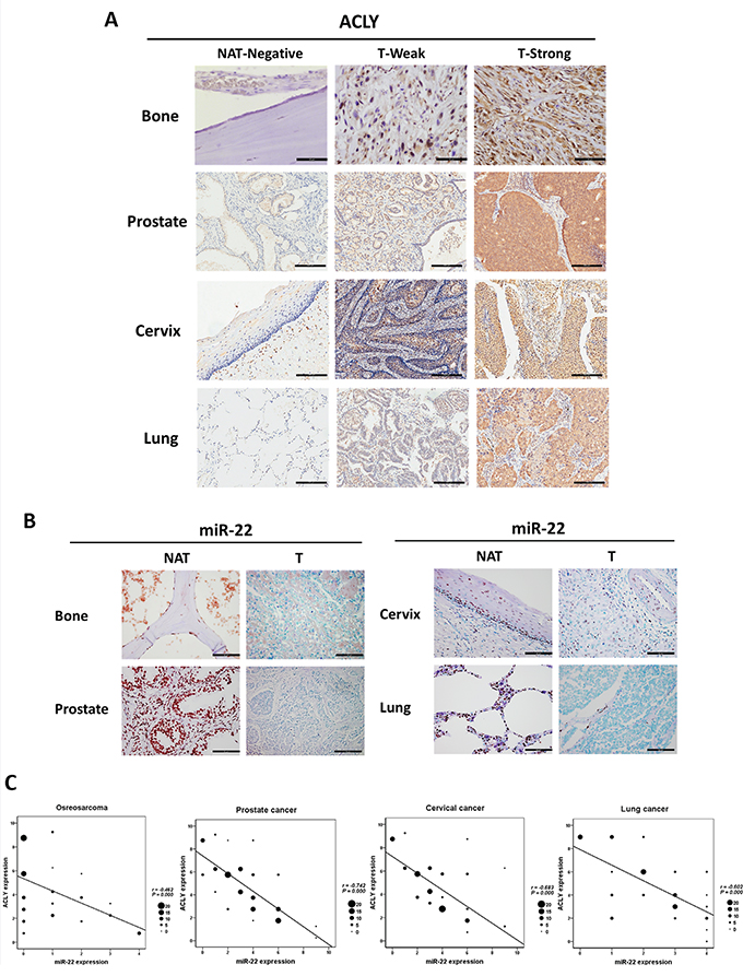 Verifications of the downregulation relationship between the ACLY protein and miR-22 in the clinical samples of osteosarcoma, prostate, cervical and lung cancers.