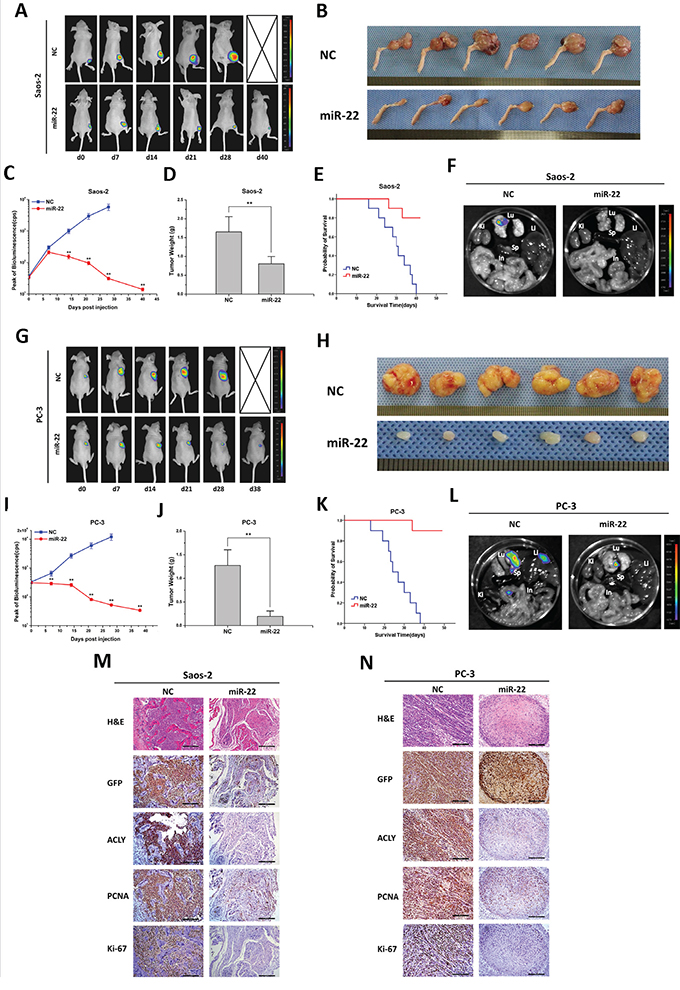 miR-22 suppresses tumor growth and metastasis in animal models of osteosarcoma and prostate cancer.