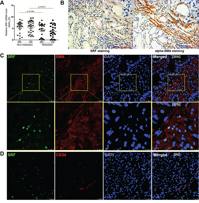 Characterization of SRF expression in gastric carcinoma tissues.