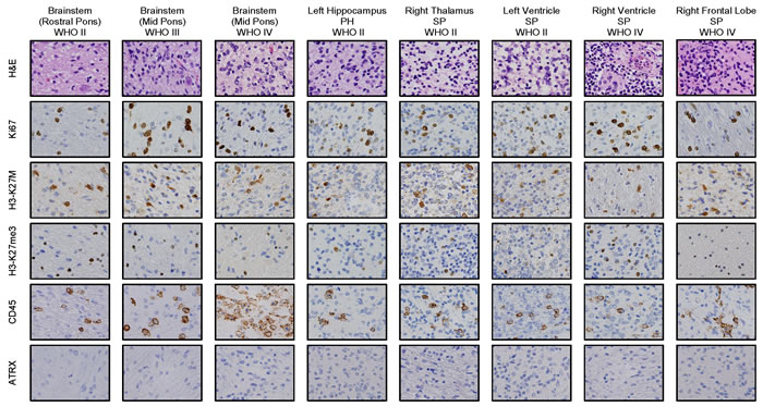 Immunostaining of primary site of tumor and tumor metastases to left hippocampus (WHO grade II, PH lesion), and SP tumor: right thalamus (WHO grade II), left ventricle (WHO grade II), right ventricle (WHO grade IV) and right frontal lobe (WHO grade IV) show histone 3 K27M (H3K27M) mutation and decreased H3K27 trimethylation (H3K27me3).