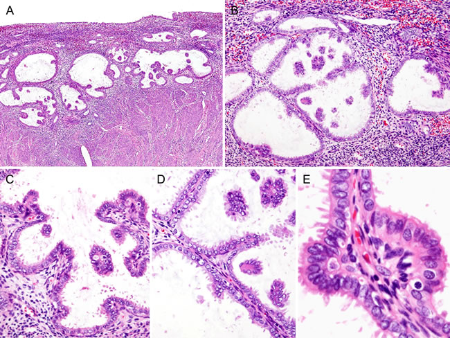 Histopathological findings of Case 1: Simple papillary proliferation, incidentally detected.