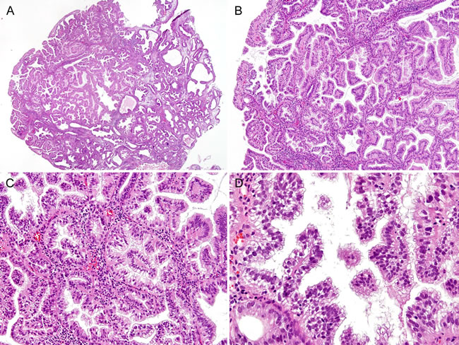 Histopathological findings of Case 2: Complex papillary proliferation, extensively involving an endometrial polyp.