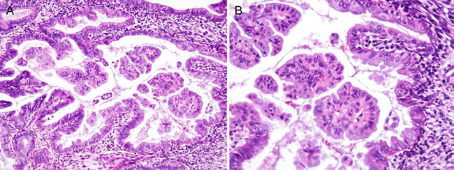 Histopathological findings of Case 3: Simple papillary proliferation, showing apparent mucinous metaplasia.