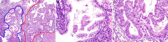 Histopathological findings of Case 4: Simple papillary proliferation, closely adjacent to a well-differentiated endometrioid carcinoma.