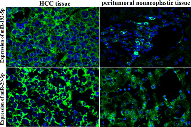 High expression of miR-192-5p and miR-29a-3p in HCC tissues by FISH.