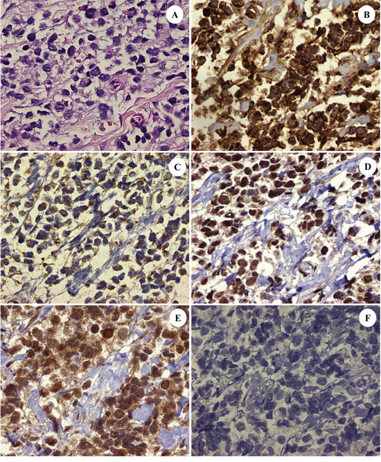 The patient&#x0027;s ARMS, PAX3-FKHR subtype with: H&#x0026;E stained section showing dedifferentiated tumor cells