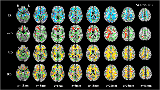 Group differences between normal controls (NC) and subjective cognitive decline (SCD).