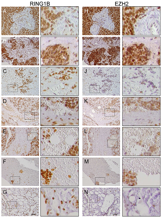 RING1B and EZH2 expression in primary Ewing sarcoma (ES) tumors.