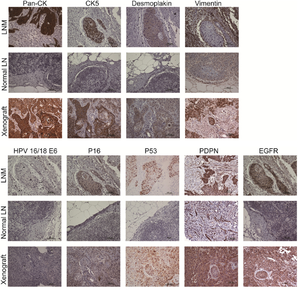 Immunophenotype of indicated cellular biomarkers and HPV subtype markers among LNM, normal lymph nodes and xenografted tumors.