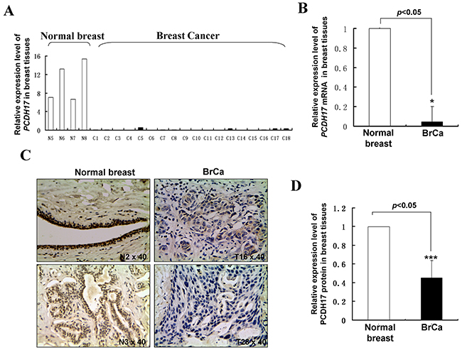 PCDH17 expression in breast tumor tissues.