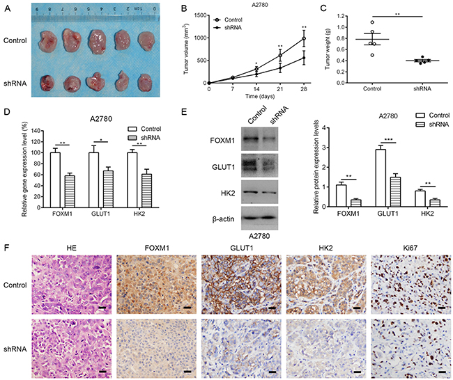 Knocking down FOXM1 expression in human EOC cells reduces tumorigenic properties.