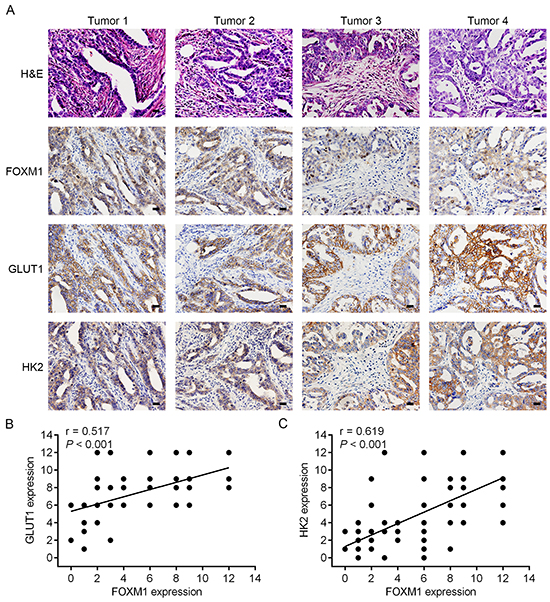 Concomitant expression of FOXM1, GLUT1 and HK2 in EOC patient specimens by immunohistochemical analysis.