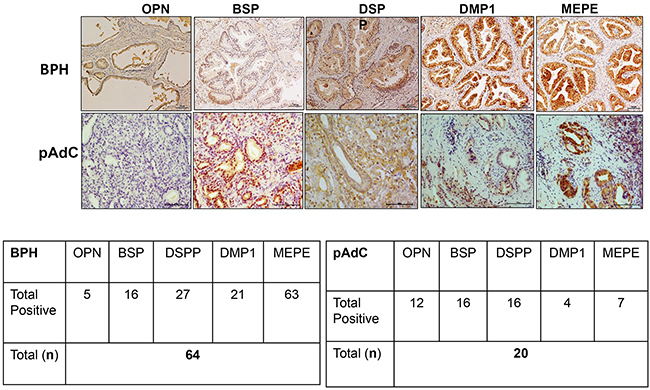 IHC on BPH and pAdC tissue sections showing positive immunoreactivity for the SIBLINGs.