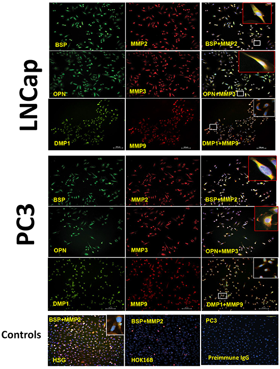 Co-localization of the SIBLINGs and their cognate MMPs in prostate cancer cell lines.