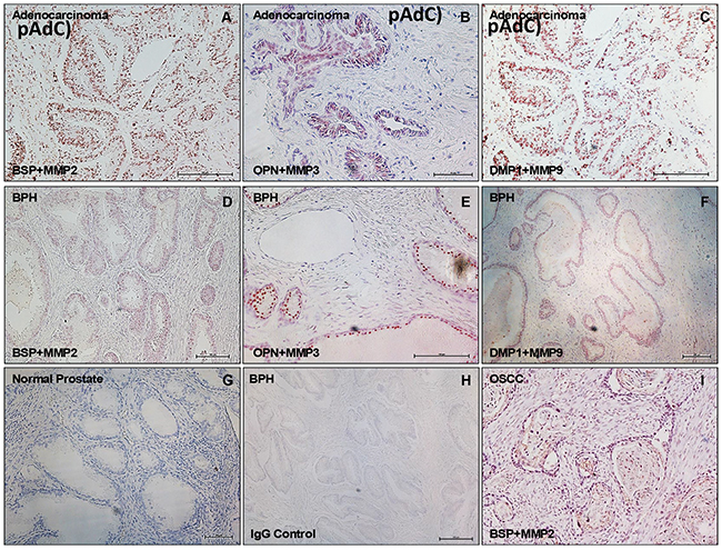 SIBLING-MMP interaction in prostatic neoplasms.