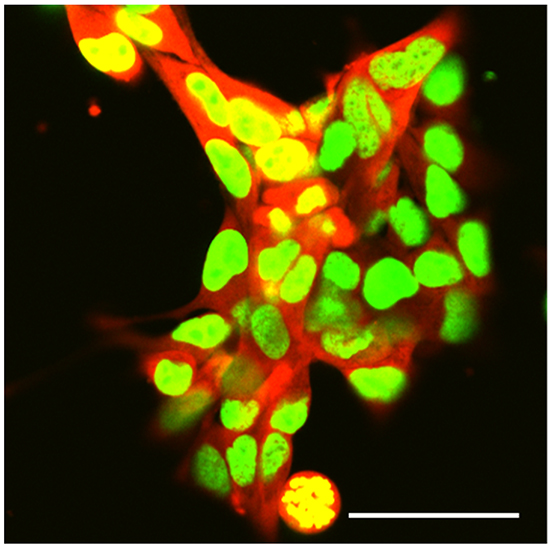 Dual-color selected 143B-LM4 human osteosarcoma cells expressing GFP in the nucleus and RFP in the cytoplasm in vitro.