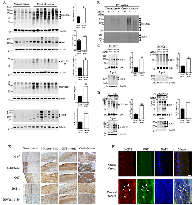 The levels of O-GlcNAcylation, OGT, E6, E7 and O-GlcNAcylation of HCF-1 levels are elevated in cervical cancer tissues.