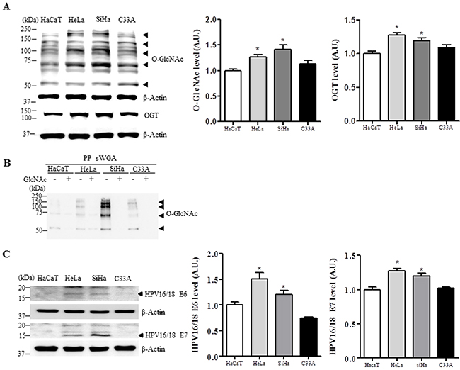 Levels of O-GlcNAc, OGT, E6 and E7 are elevated in HPV-type 16/18-positive human cervical cancer cell lines.