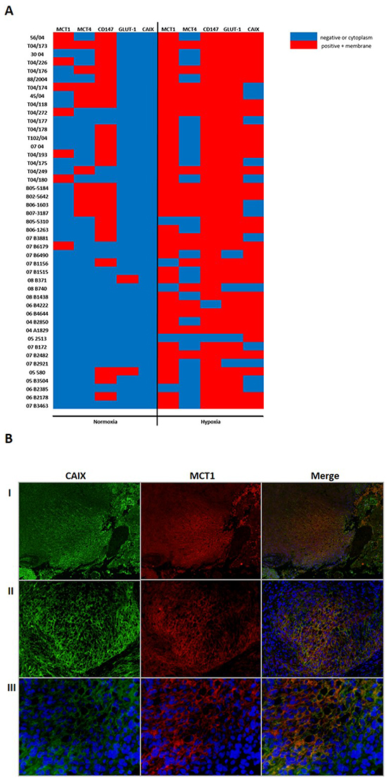 Association of MCTs and CD147 expression with hypoxia markers (GLUT-1 and CAIX) in GBMs.
