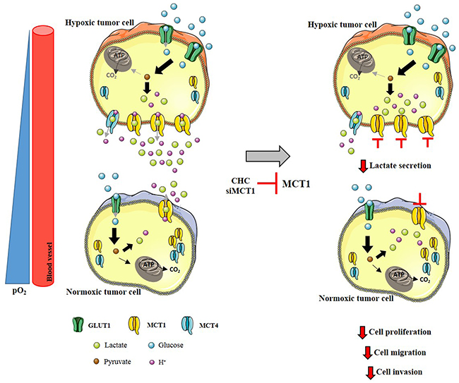 MCT1 as a mediator of aggressiveness at hypoxic regions in glioblastomas.