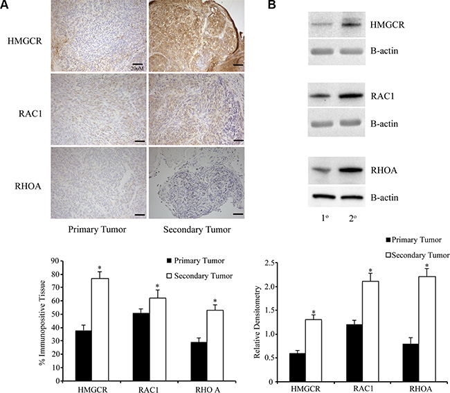 Metastatic peritoneal tumors have increased expression of members of the mevalonate pathway.