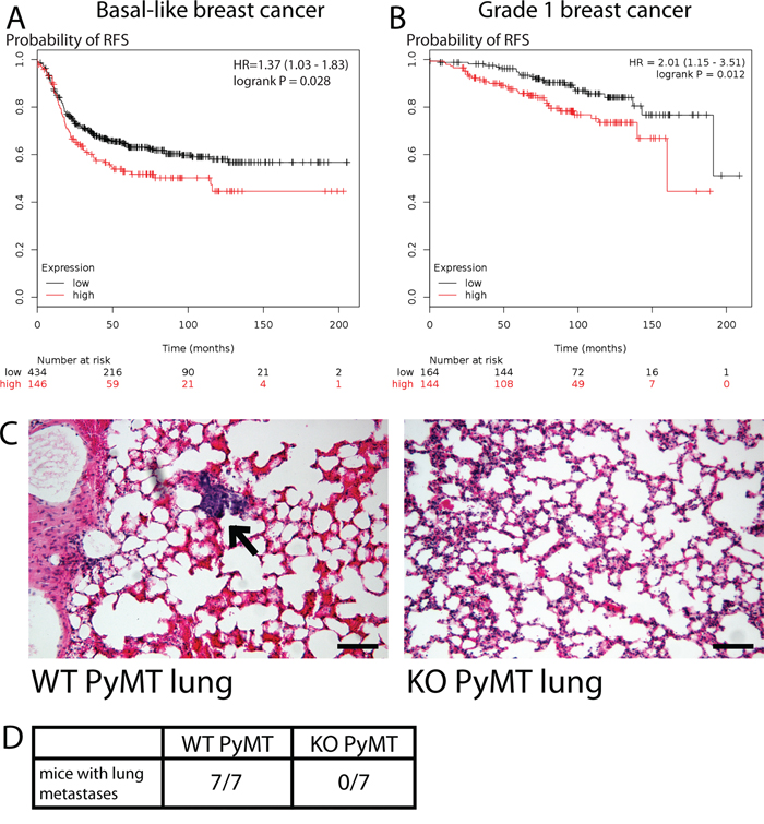 MYO1E expression correlates with poor breast cancer patient outcome and regulates tumor cell metastasis.