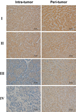Tissue microarray analysis of IL-35 expression in hepatocellular carcinoma tissues.
