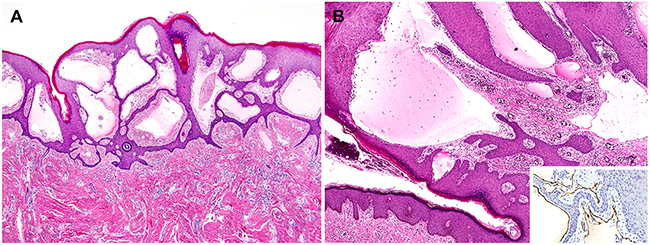 Histopathological findings of vulvar lymphangioma circumscriptum.