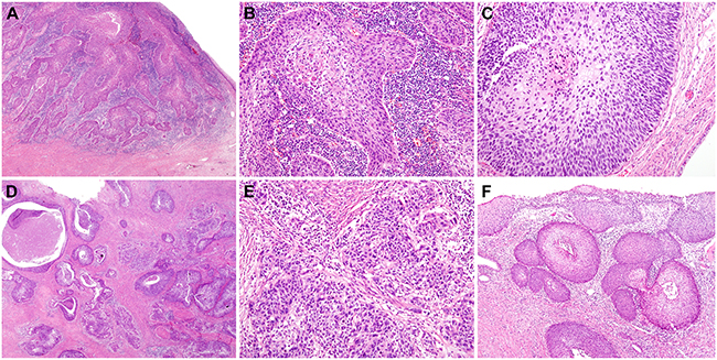 Histopathological findings of previous cervical cancer: (A to C) Case 1.