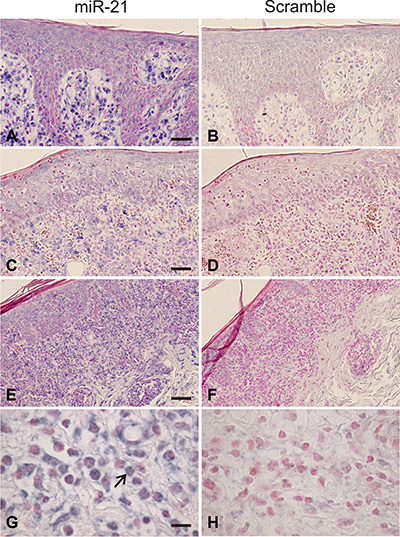 In situ hybridization for miR-21 in mycosis fungoides.