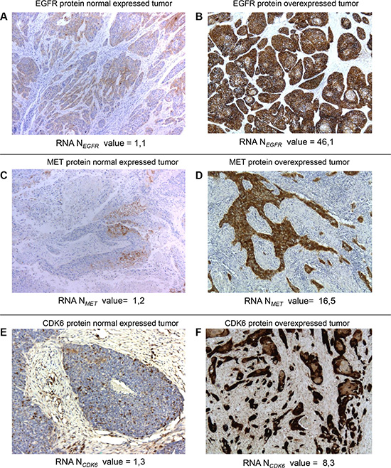 Normal and overexpressed tumors at the protein and mRNA levels for EGFR, MET and CDK6