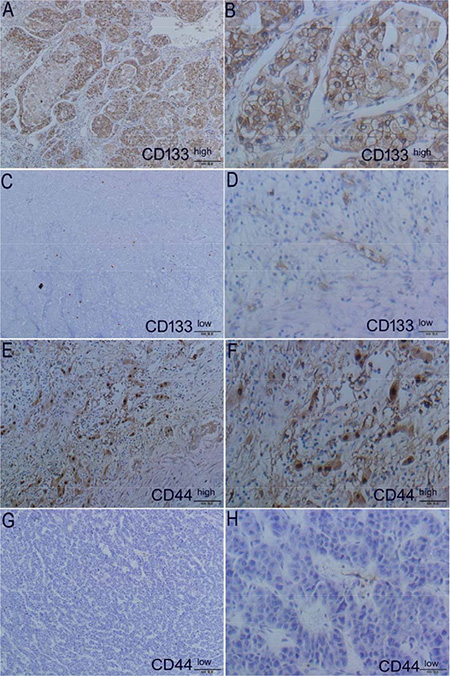 Expression of markers CD133 and CD44 in tumors using HE staining (left panel) and IHC (right panel) from patients.