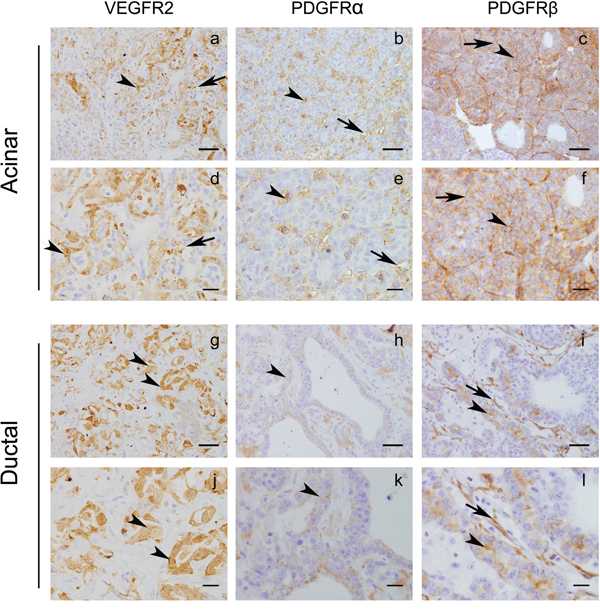 Ela-myc tumors express tyrosine kinase receptors that can be targeted by sunitinib.