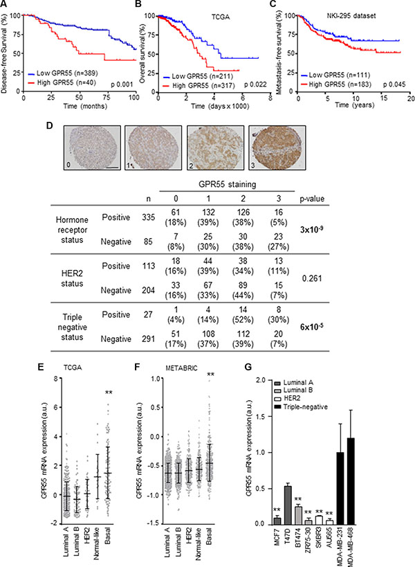 GPR55 expression correlates with triple-negative tumors and poor patient prognosis.