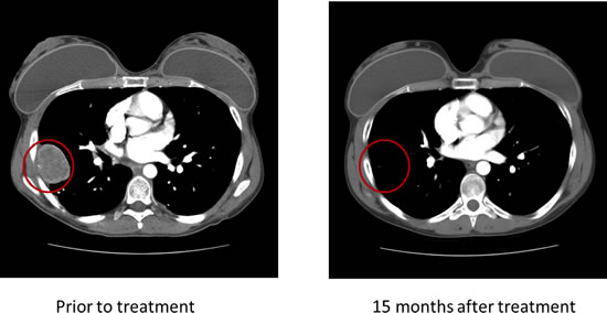 Patient 1 demonstrated a durable complete response to therapy with an IGF-1R inhibitor.