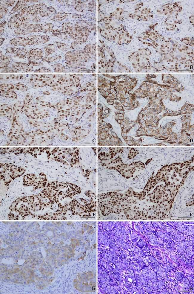 Location of immunohistochemical staining of each protein marker in invasive breast cancer tissues.